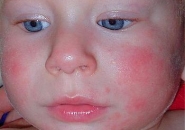 Аллергия на цитрусовые 445