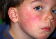 Аллергия на цитрусовые фото