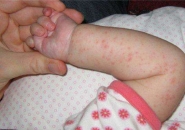аллергии на белок у детей