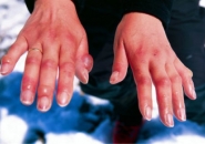 аллергия на холод на руках