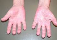 аллергия на холод руки
