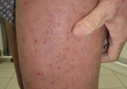 Атопический дерматит фото нога