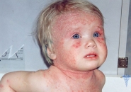 Атопический дерматит у детей лечение