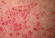 Атопический дерматит кожа