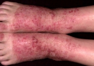 Атопический дерматит фото ноги