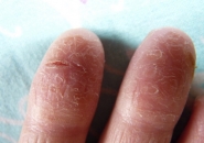 дерматит пальцы