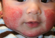 Атопический дерматит у детей фото 3