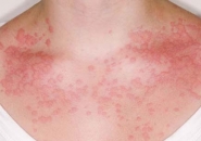 Аллергия на цитрусовые 2131