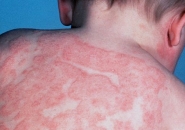 Атопический дерматит у детей фото 5