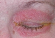Аллергия вокруг глаз фото
