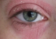 Аллергия вокруг глаз фото 2