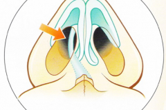 Искривление носовой перегородки