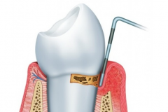 Лечение пародонта