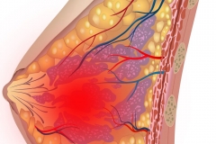 Киста молочной железы