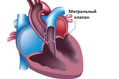 Врожденная недостаточность митрального клапана