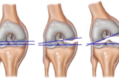 Повреждения связок коленного сустава