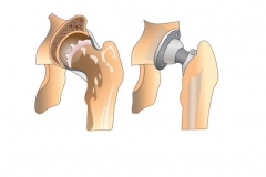 Осложнения после эндопротезирования тазобедренного сустава