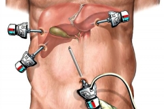 Лапароскопическая холецистэктомия