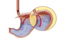 Лечение гастроэзофагеальной рефлюксной болезни