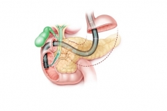 Эндоскопическая папиллосфинктеротомия