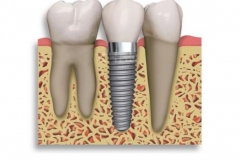 Имплантация одиночных зубов