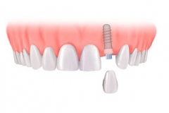 Протезирование одиночных зубов