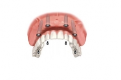 Несъемные протезы с опорой на имплантаты