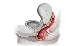 Пролапс гениталий у женщин