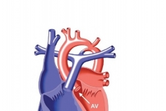 Перерыв дуги аорты у новорожденных