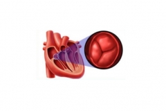 Пороки трехстворчатого клапана