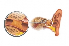 Серная пробка в ухе