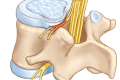 Протрузия позвоночника
