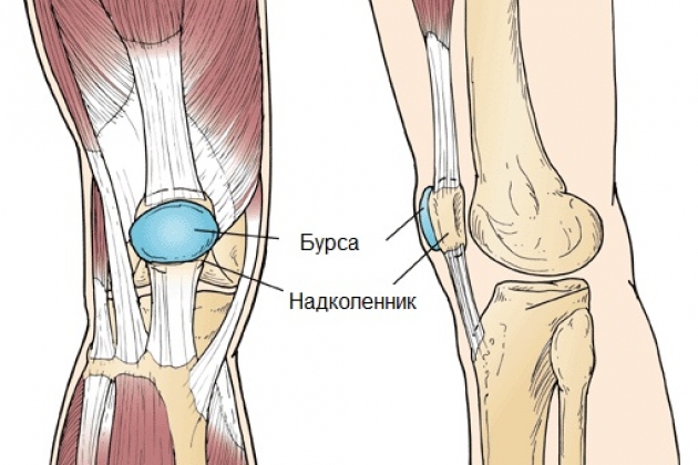 Бурсит коленного сустава