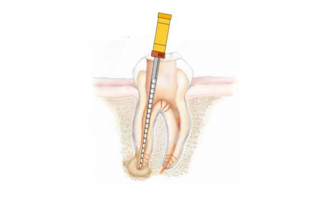 Реплантация зуба