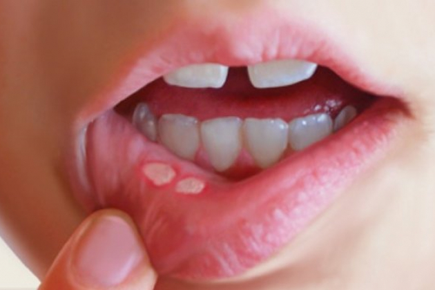 Как лечить язвы во рту?