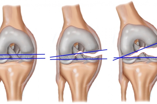 Повреждения связок коленного сустава