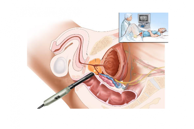Ультразвуковая диагностика простаты