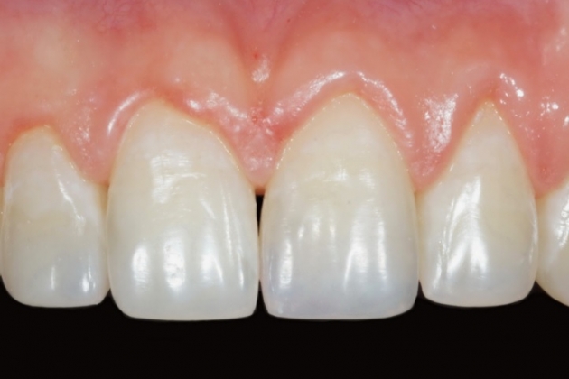 Особенности восстановления передних зубов