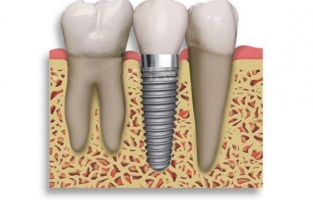 Имплантация одиночных зубов