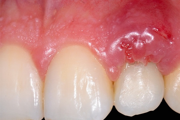Осложнения при имплантации зубов