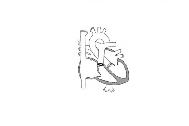 Изолированный клапанный стеноз легочной артерии