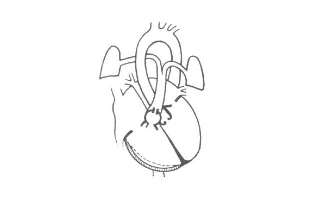 Классификация врожденных пороков сердца
