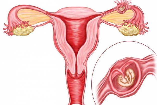 Признаки внематочной беременности