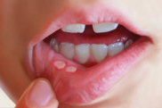 Как лечить язвы во рту?