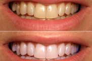 Химическое отбеливание зубов