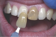 Внутреннее отбеливание зубов