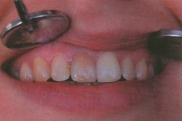 Лечение временных зубов
