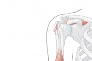 Диафизарные переломы плечевой кости