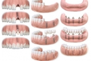 Восстановление всех зубов верхней челюсти
