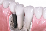 Выбор материала для зубного имплантата